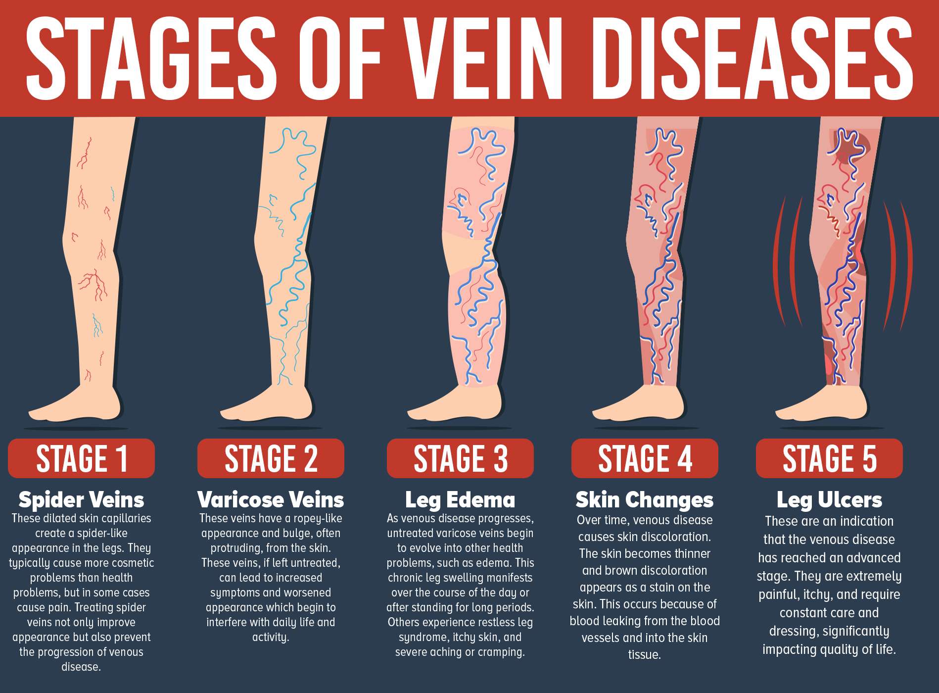 Don't Let Varicose Veins Get You Down. Treatment Is ...
