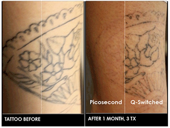Dr. Michael Kerin’s Answer To Tattoo Regret With The PicoSure Laser