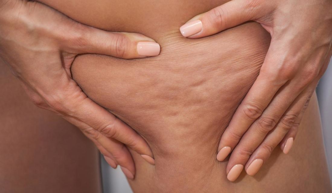 Can Cellulite be Genetic?