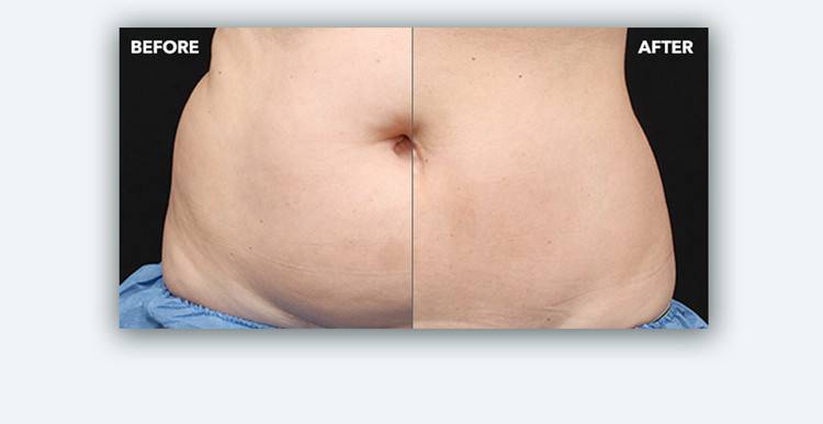 Will CoolSculpting Help You Lose Weight?