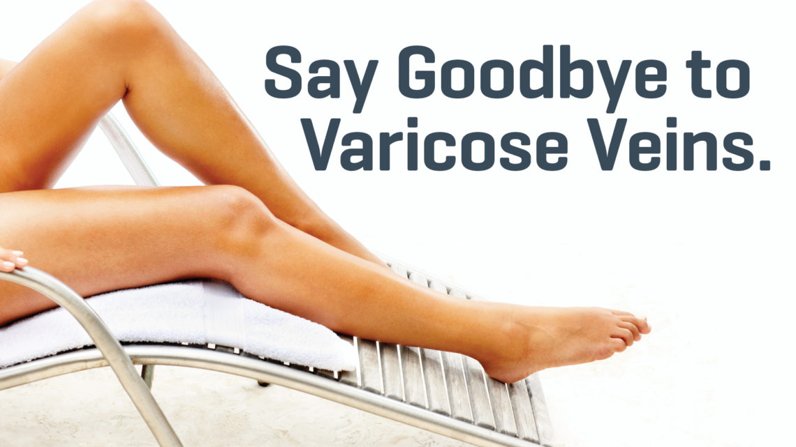 Don’t Let Varicose Veins Get You Down. Treatment Is Available!