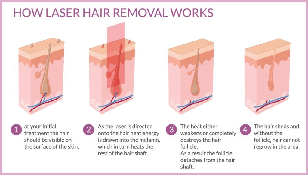 More About Laser Hair Removal Dr. Michael Kerin Blog